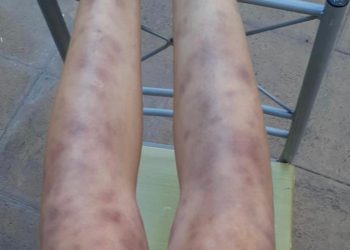 Docente porteña acusa graves complicaciones de salud tras recibir vacuna Pfizer: vasculitis la tuvo dos días sin caminar