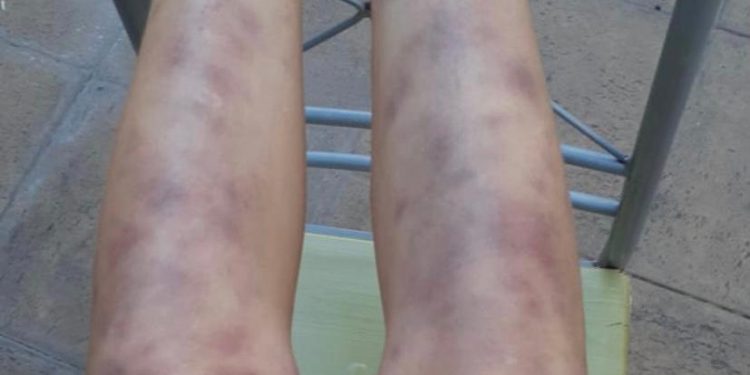 Docente porteña acusa graves complicaciones de salud tras recibir vacuna Pfizer: vasculitis la tuvo dos días sin caminar