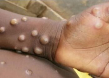 Minsal descartó caso de viruela del mono en Concepción