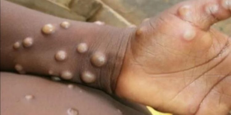 Minsal descartó caso de viruela del mono en Concepción