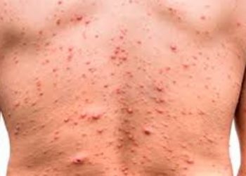 Primer chileno reportado con la viruela del mono permanece aislado en Italia