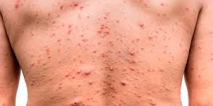 Primer chileno reportado con la viruela del mono permanece aislado en Italia