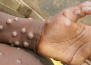 Minsal anuncia medidas para detectar a contagiados con viruela del mono