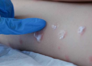 Médico infectólogo advierte: “Es muy probable que la viruela del mono llegue a Chile”