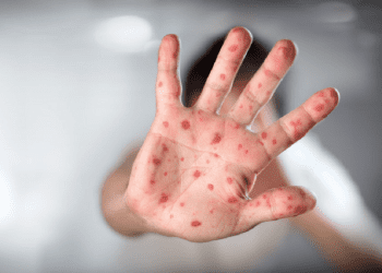 Experto sugiere reforzar vigilancia epidemiológica en las fronteras por brotes de la “viruela del mono”