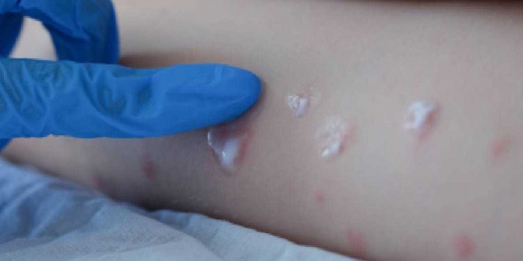 Médico infectólogo advierte: “Es muy probable que la viruela del mono llegue a Chile”