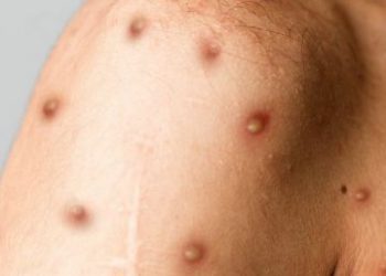 Detectan cuatro casos sospechosos de viruela del mono en Uruguay