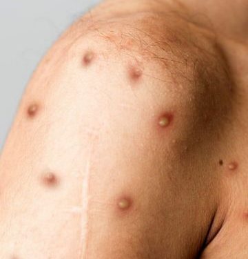 Detectan cuatro casos sospechosos de viruela del mono en Uruguay