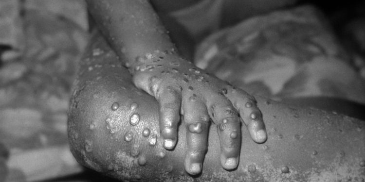 Ministerio de Salud confirma segundo caso de «viruela del mono» en Chile