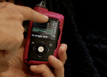 Pacientes pediátricos renuevan sus bombas de insulina en el Hospital Gustavo Fricke de Viña del Mar