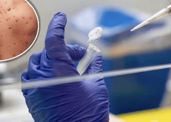 Nueva York declara estado de emergencia por ser el «epicentro de viruela del mono»