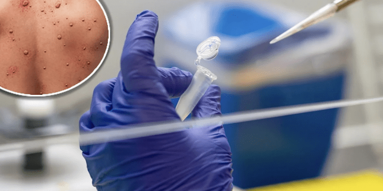 Nueva York declara estado de emergencia por ser el «epicentro de viruela del mono»