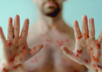 Coordinadora académica del ISP UNAB Viña del Mar analiza la situación actual de la viruela símica en Chile y el mundo