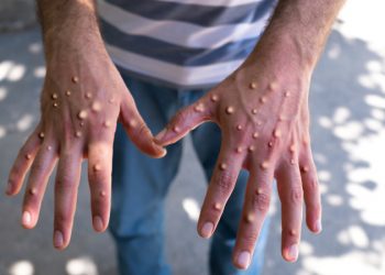 Fallece la primera persona por viruela del Mono en Chile