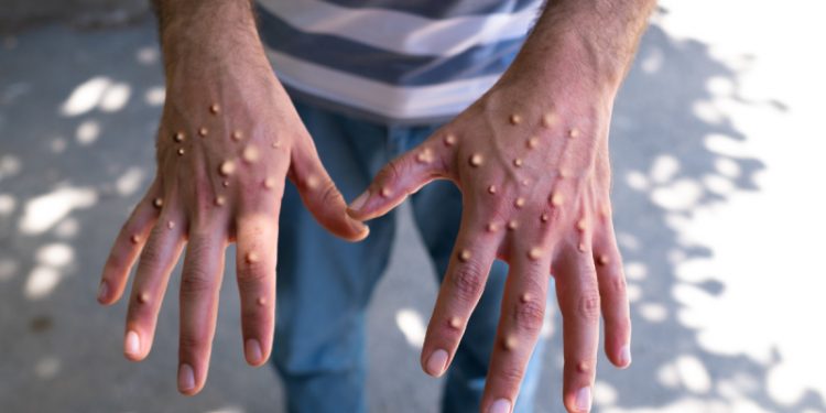 Fallece la primera persona por viruela del Mono en Chile