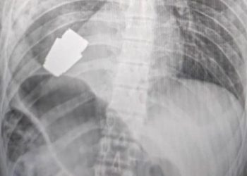 Extraen granada sin detonar desde el cuerpo de soldado ucraniano