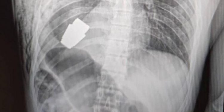 Extraen granada sin detonar desde el cuerpo de soldado ucraniano