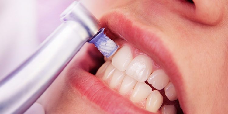 5 consejos para evitar la aparición de sarro en los dientes