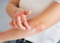 Psoriasis: una enfermedad crónica que afecta a la piel y las articulaciones