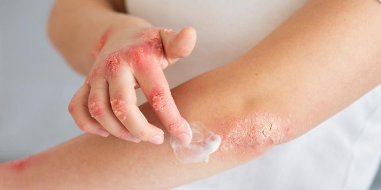 Psoriasis: una enfermedad crónica que afecta a la piel y las articulaciones
