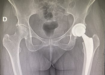 Traumatólogo aborda las principales causas que motivan una cirugía de prótesis de cadera