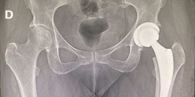 Traumatólogo aborda las principales causas que motivan una cirugía de prótesis de cadera