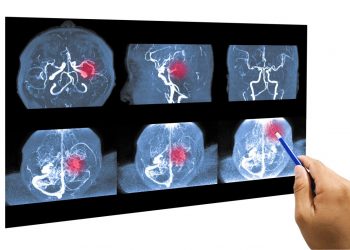 Qué es un Accidente Cerebrovascular, cuándo ocurre y cómo prevenirlo