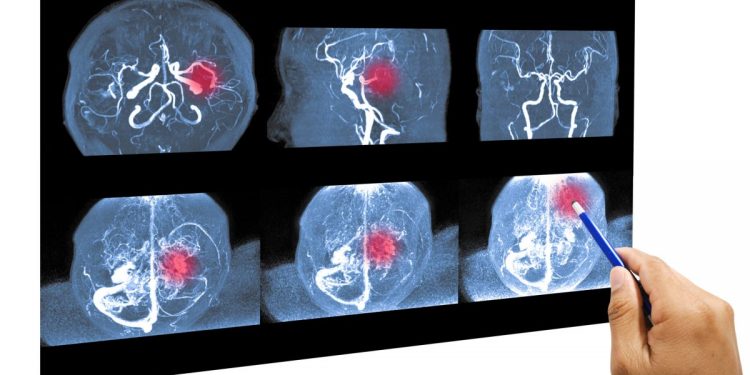 Qué es un Accidente Cerebrovascular, cuándo ocurre y cómo prevenirlo