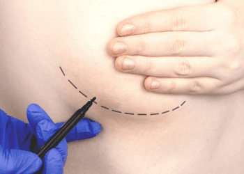 Cirujano plástico destaca los beneficios de la mastopexia en mujeres que han sufrido de obesidad