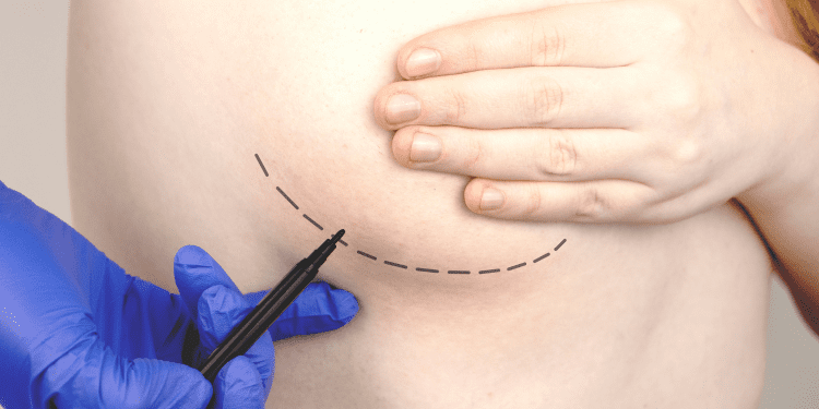 Cirujano plástico destaca los beneficios de la mastopexia en mujeres que han sufrido de obesidad