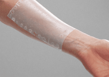 Hospital Dr. Gustavo Fricke SSVQP realiza tratamiento para quemados con tecnología en apósitos biosintéticos