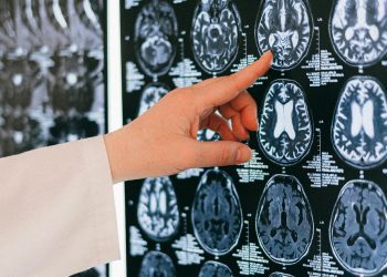 La detección temprana del infarto cerebrovascular: clave para salvar vidas