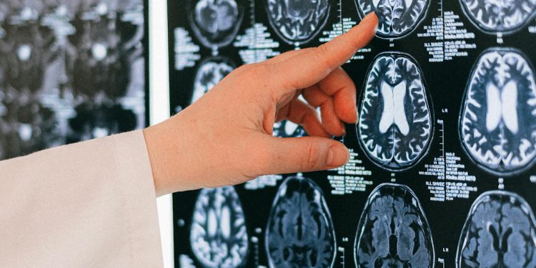 La detección temprana del infarto cerebrovascular: clave para salvar vidas