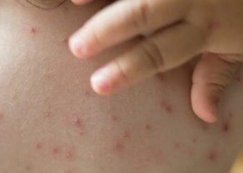 “Potencialmente pandémica”: alerta por nueva cepa de viruela del mono