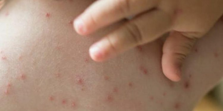 “Potencialmente pandémica”: alerta por nueva cepa de viruela del mono