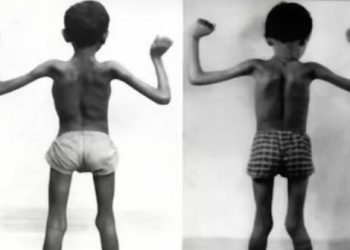 No se olviden de Duchenne