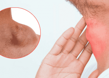 Linfoma: Un cáncer que se caracteriza por el aumento de tamaño de los ganglios