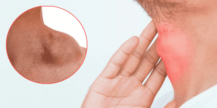 Linfoma: Un cáncer que se caracteriza por el aumento de tamaño de los ganglios