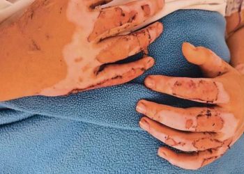 Madre de niña que resultó quemada tras un experimento en clases acusa negligencia por parte del colegio