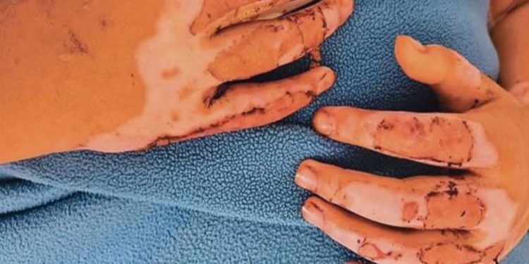 Madre de niña que resultó quemada tras un experimento en clases acusa negligencia por parte del colegio