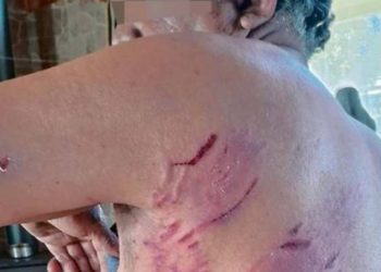 Joven de 15 años en riesgo vital para ser baleado por accidente por su amigo en Concón