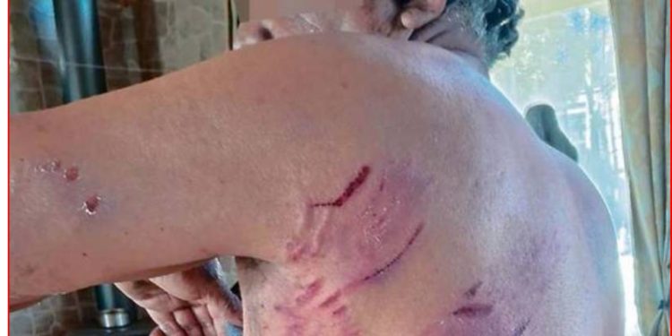 Joven de 15 años en riesgo vital para ser baleado por accidente por su amigo en Concón